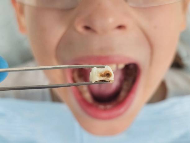 Best Emergency Tooth Extraction in Clinton, KY
